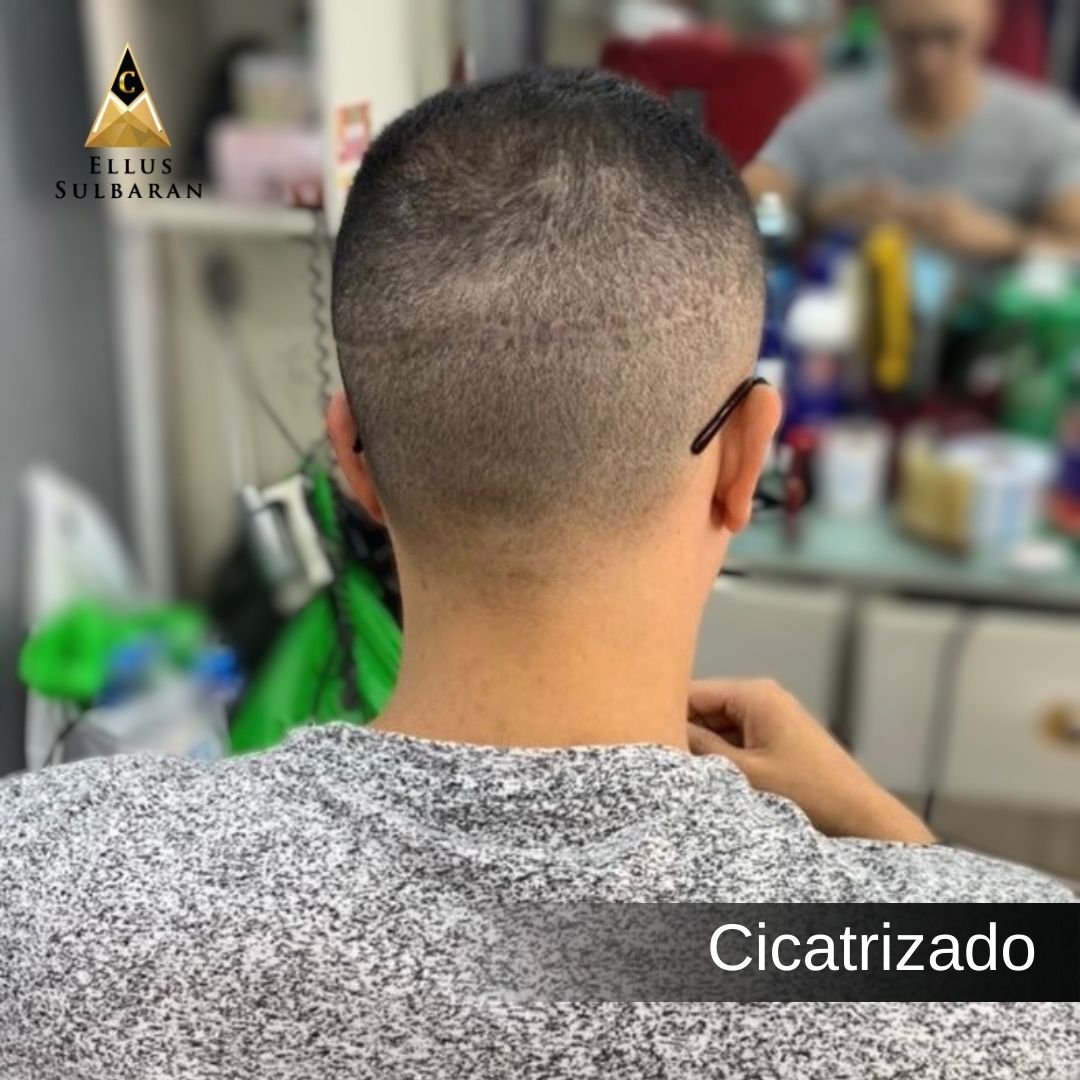 Tricopigmentacion